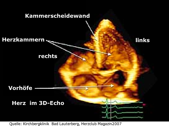 Herz 3 D Echo
